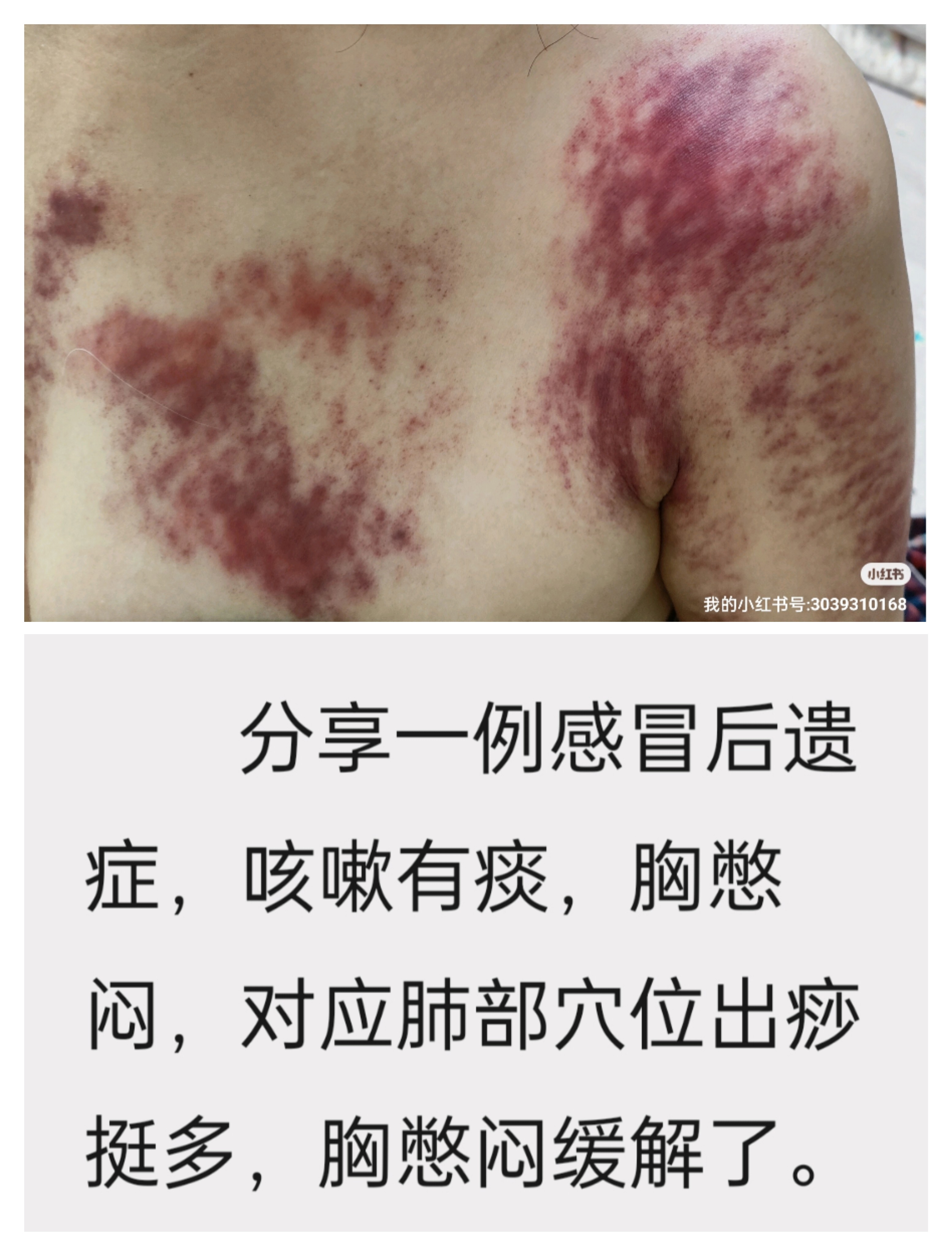 分享一例感冒后遗症,咳嗽有痰,胸憋闷,对应肺部穴位出痧挺多,胸憋闷