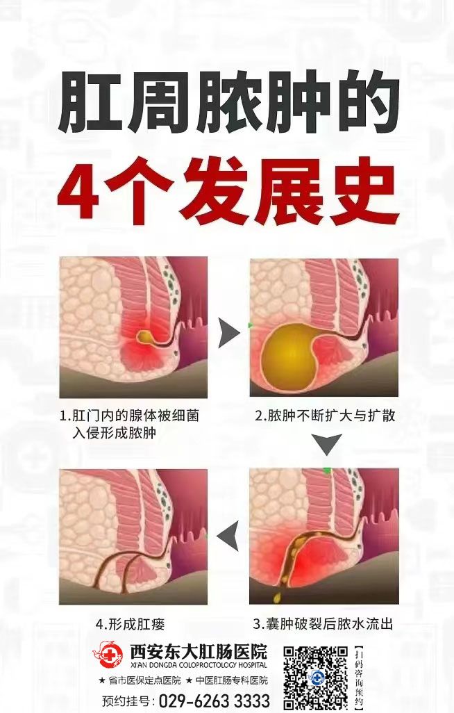 肛周毛囊炎误诊肛瘘图片