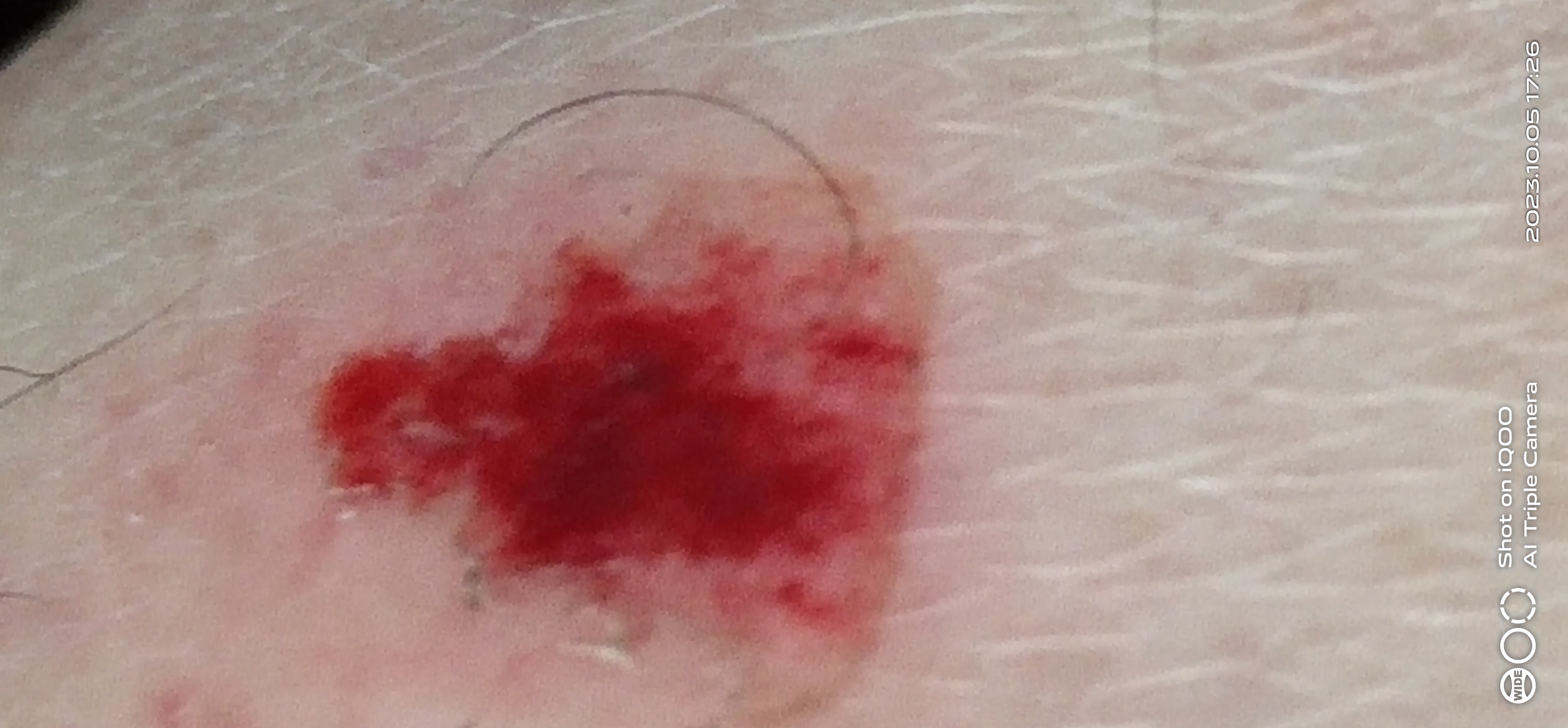 擦伤,只是表皮破损红细胞已经渗出来啦!