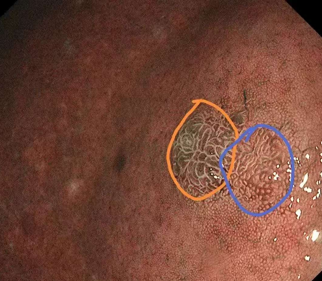 这一查,竟发现了胃早癌.幸运的是,病症尚在早期,完全治愈可期