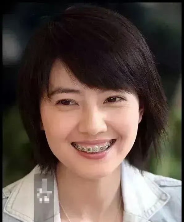 高圆圆以前也曾戴牙套矫正牙齿!挺清纯甜美的.[嘻嘻][嘻嘻][嘻嘻]