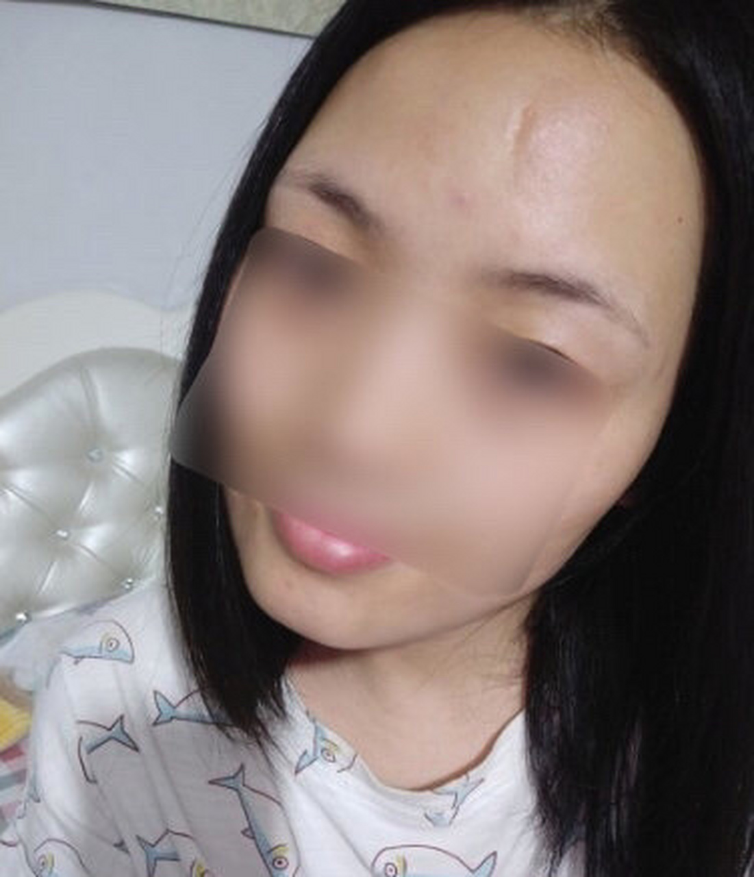 面相分析:  从面相中看,额头事业宫有个恶疤,事业运势明显会受挫,不过