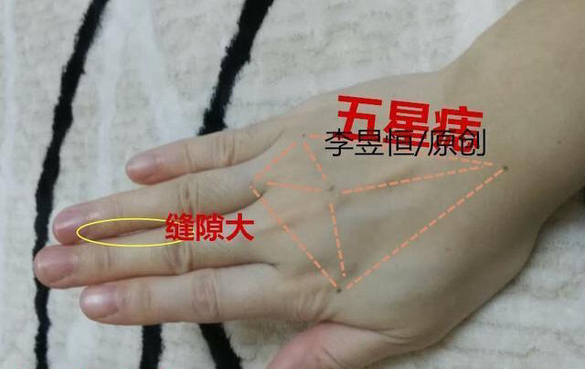 第一,五星痣:手背掌面五星痣,代表一般代表倾向于技术或者学术行业