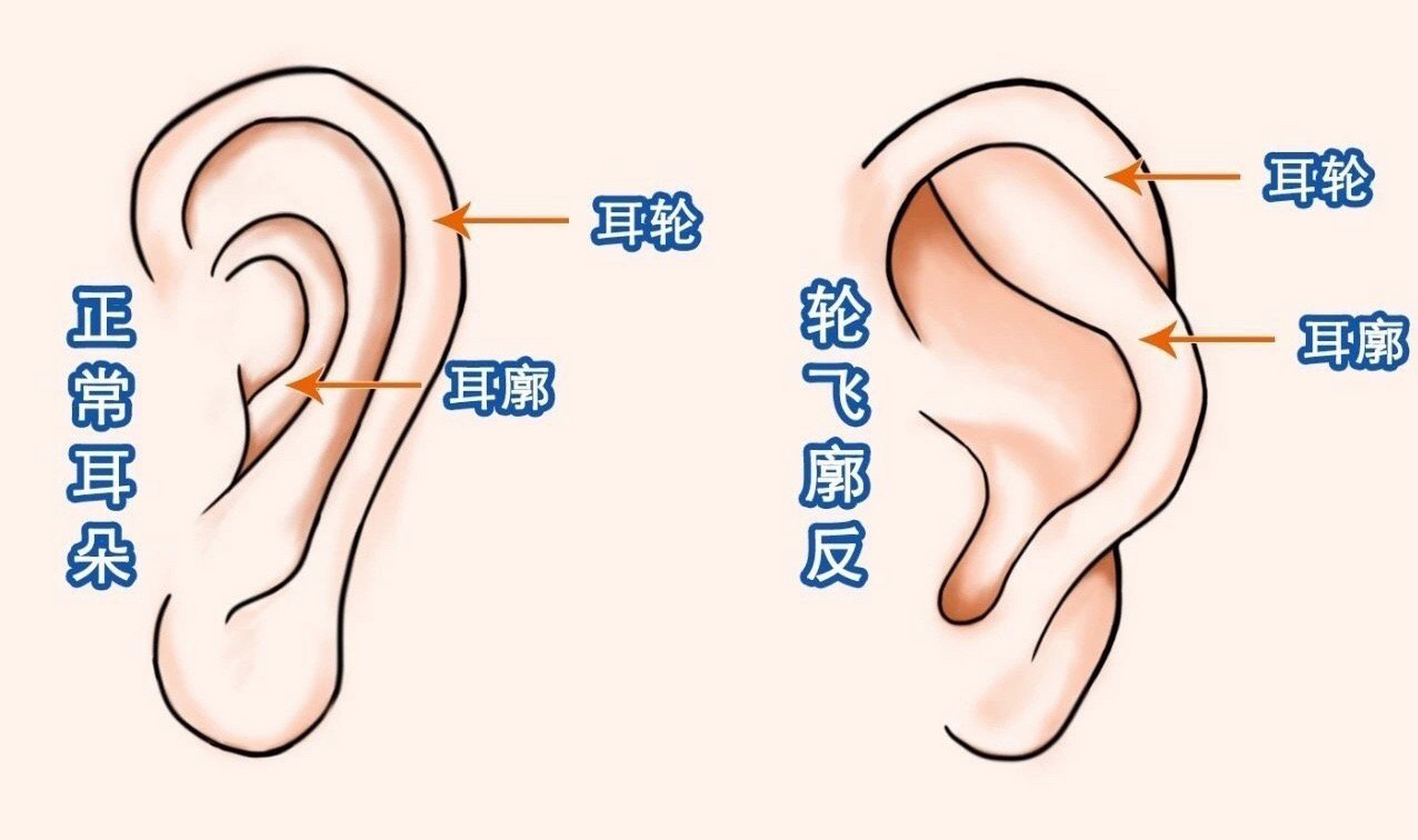 【反廓耳好不好,有什么说法?