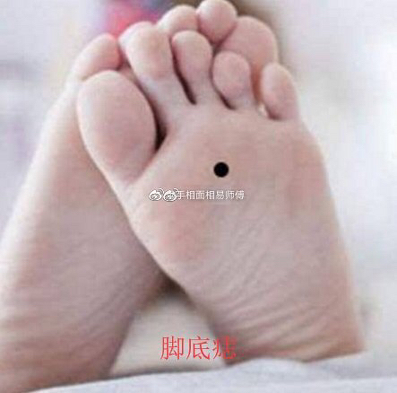 女人脚底长痣图解大全图片