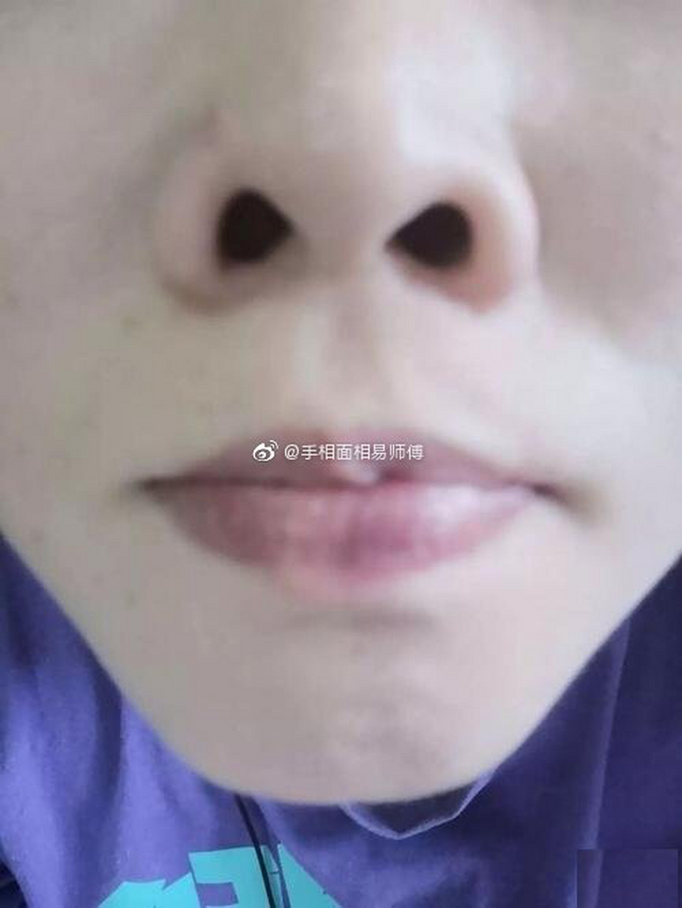 朝天鼻——顾名思义是指鼻孔朝上,鼻孔露得多,鼻梁短 朝天鼻的人都有