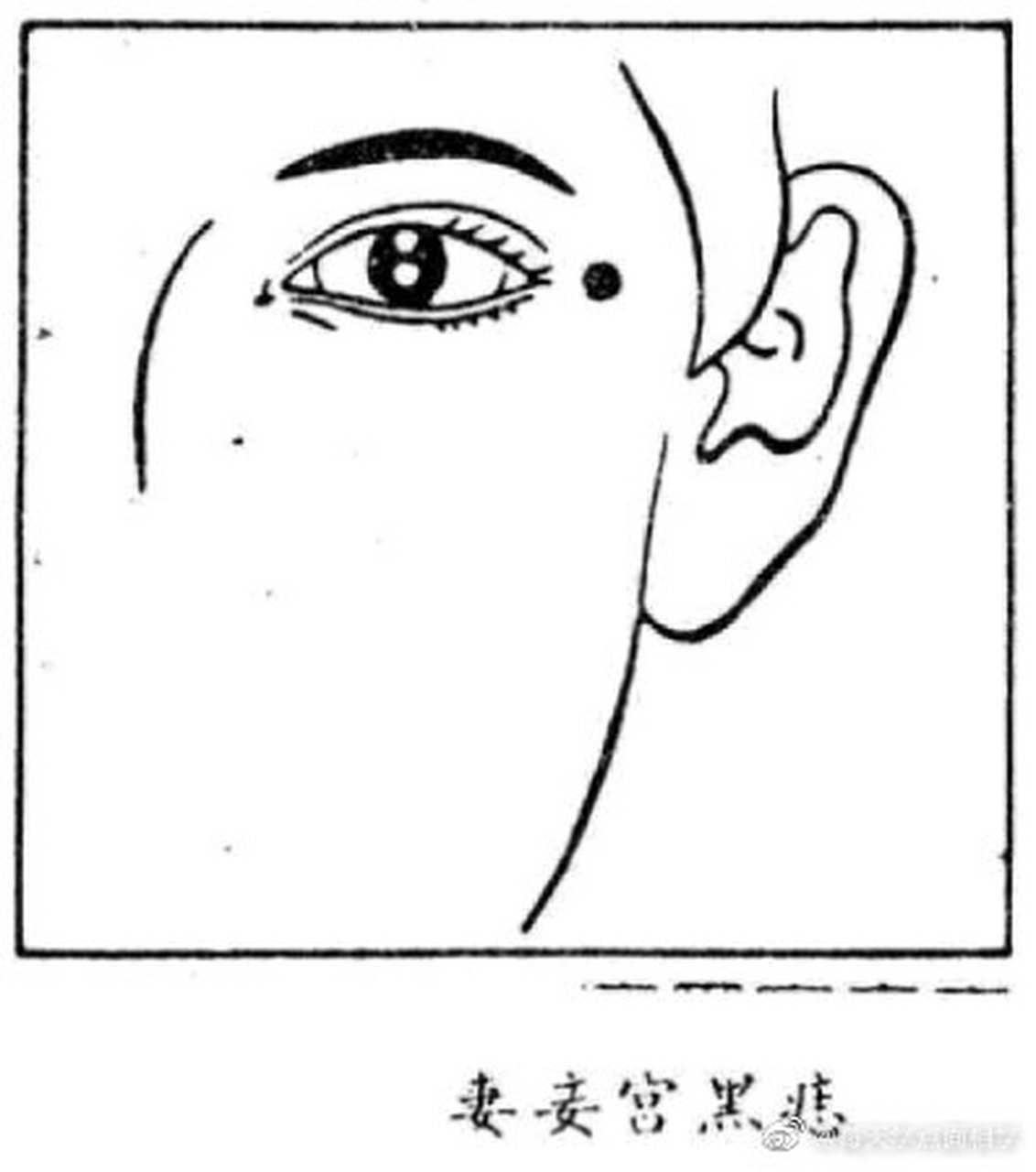 【妻妾宫黑痣】妻妾宫不宜有黑痣,男性有痣主有女难.
