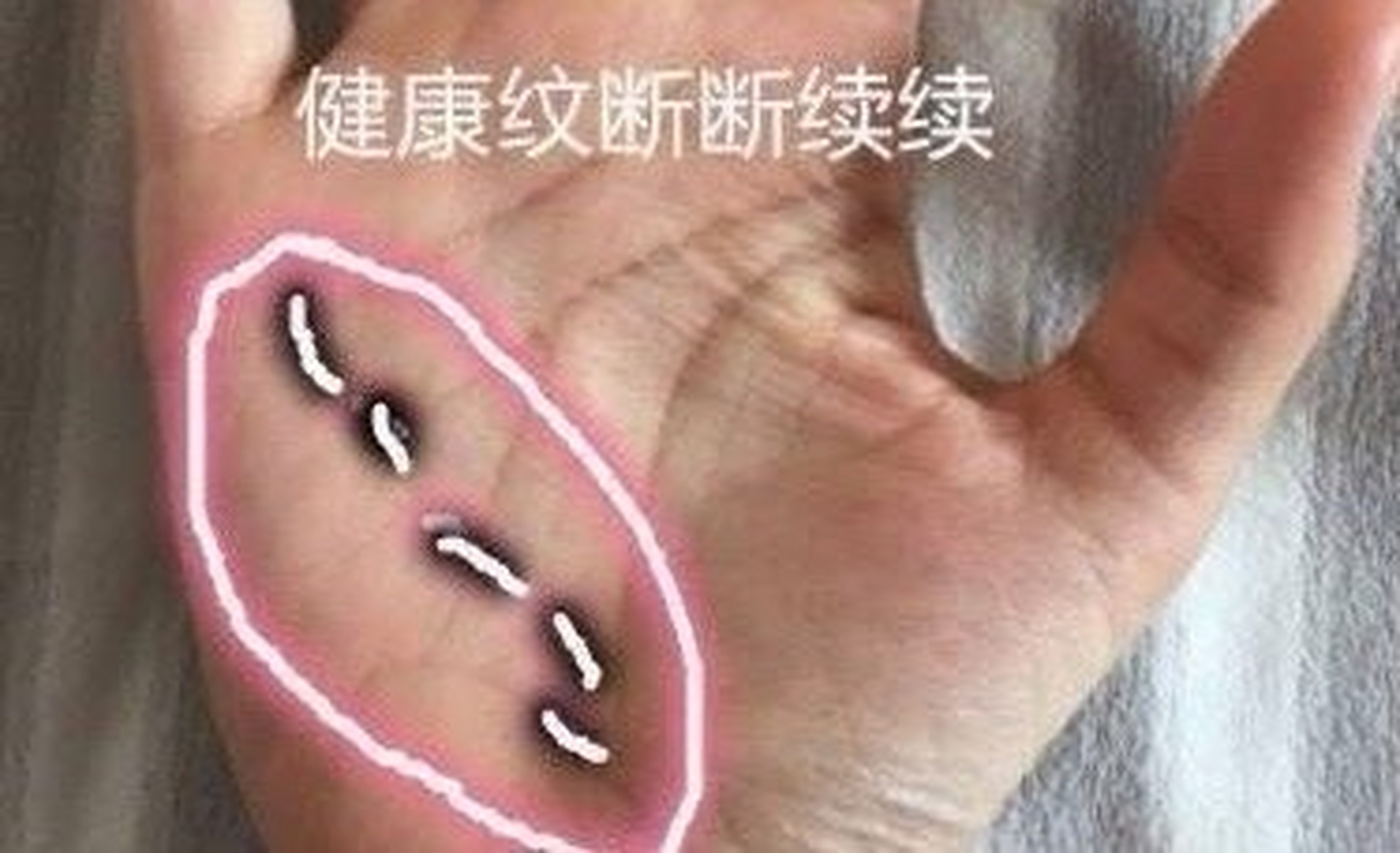 1,断脾胃健康线 断脾胃健康线呈断断续续的延伸小小指,多表示聘胃