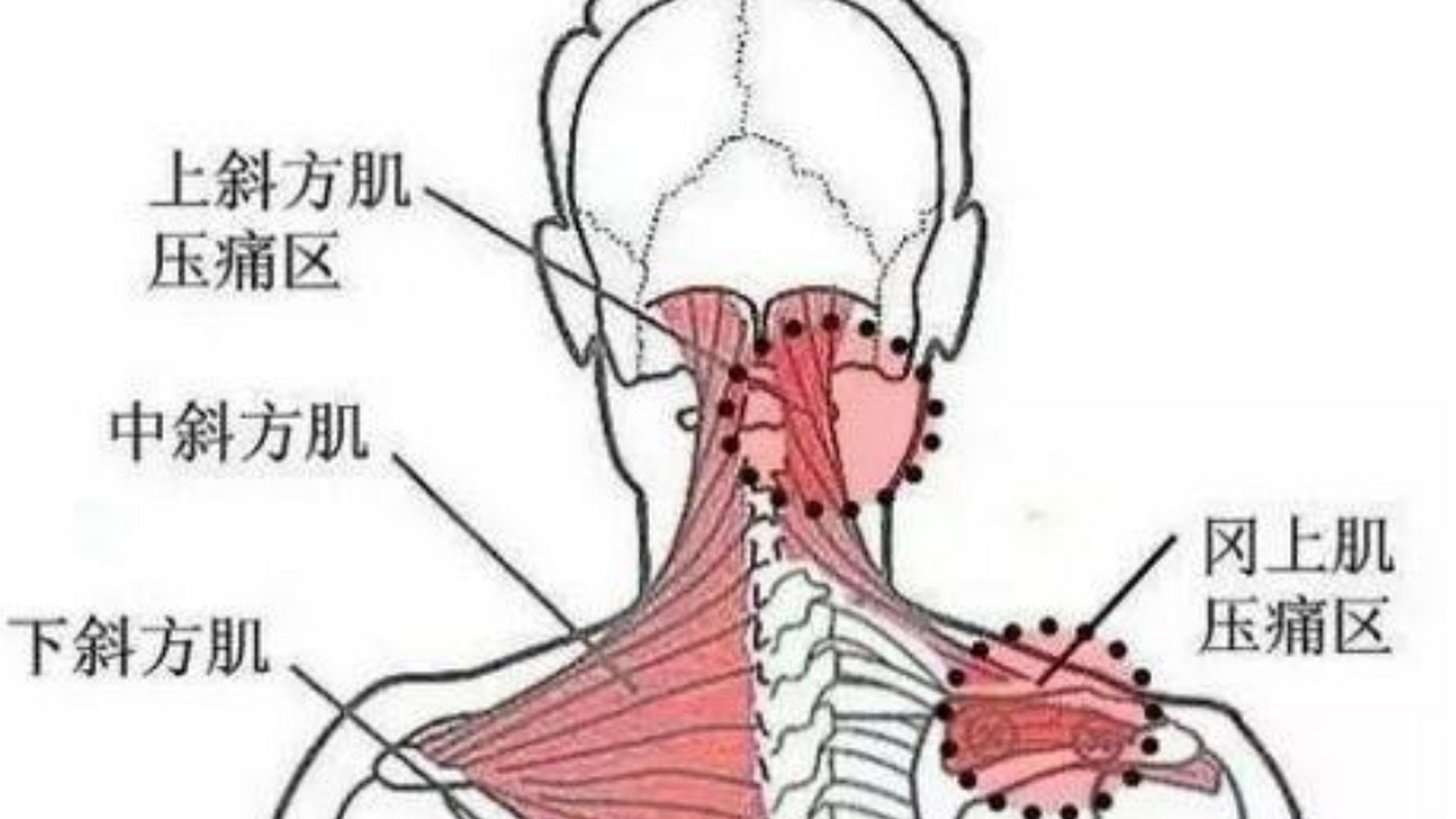 颈部筋膜炎 颈部筋膜炎的症状: 筋膜炎是指肌肉和筋膜的无菌性炎症