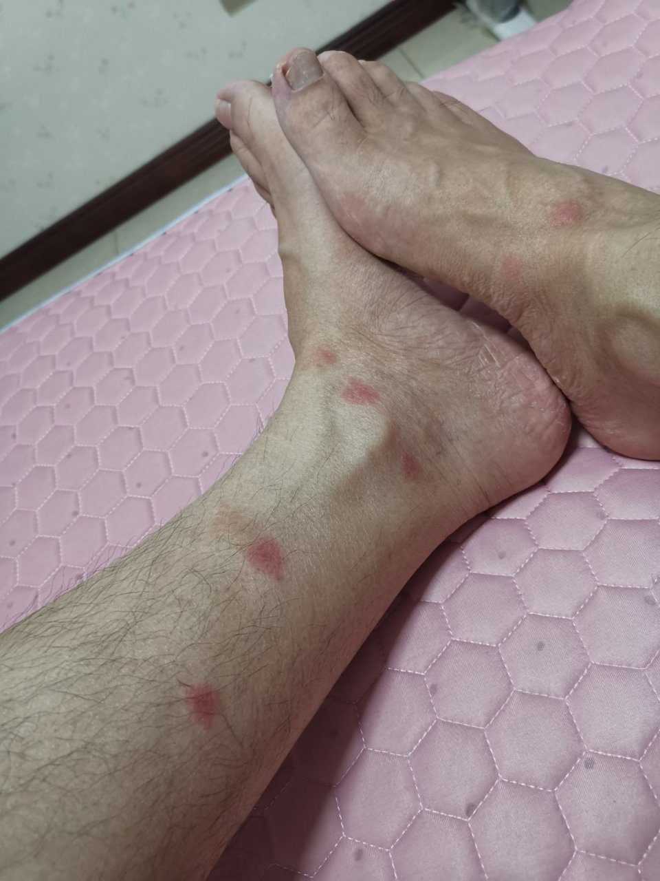 哪位高人指导脚腕旁长了红点是怎么回事?