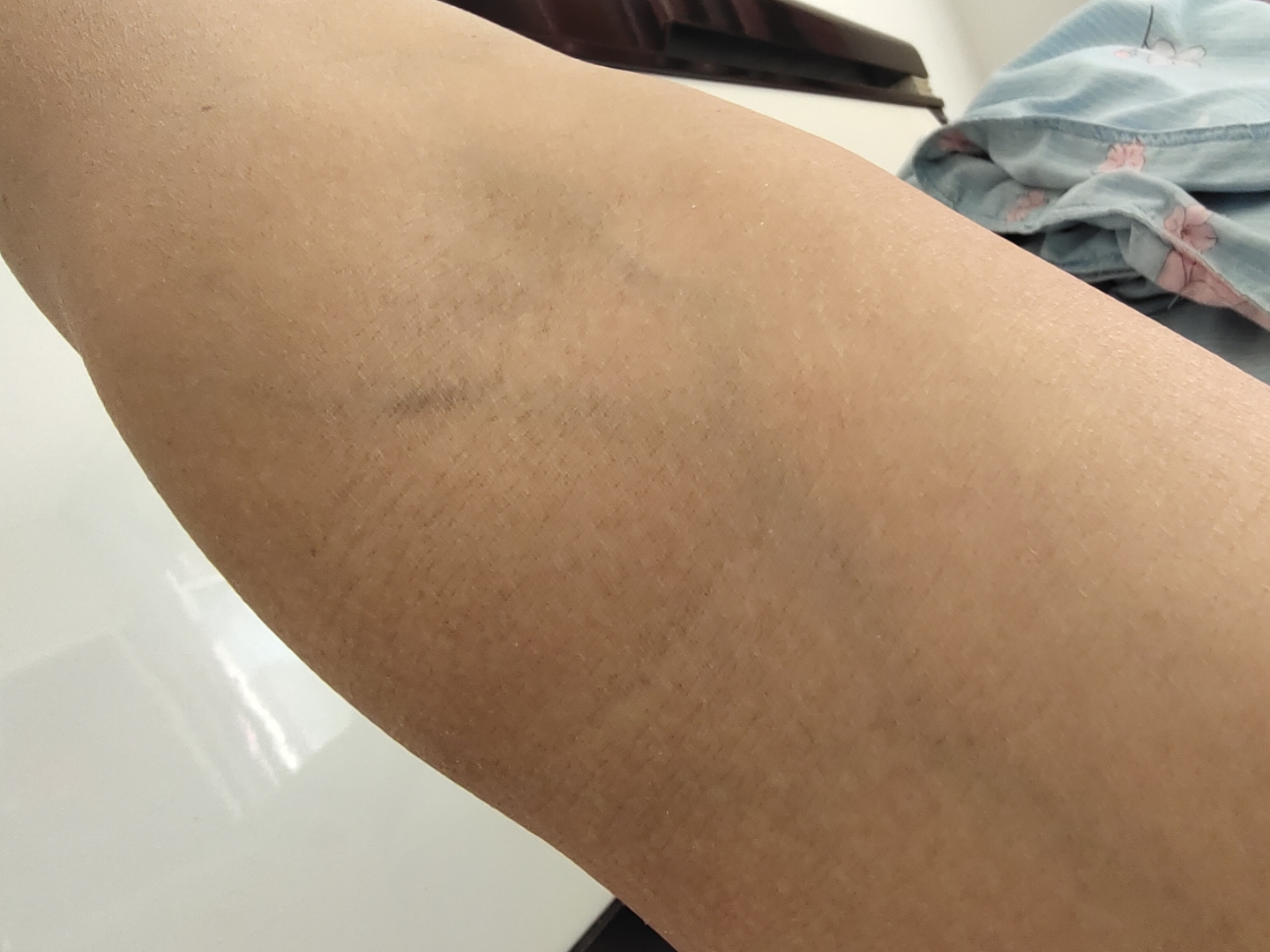 左胳膊内测血管这种情况是什么情况?