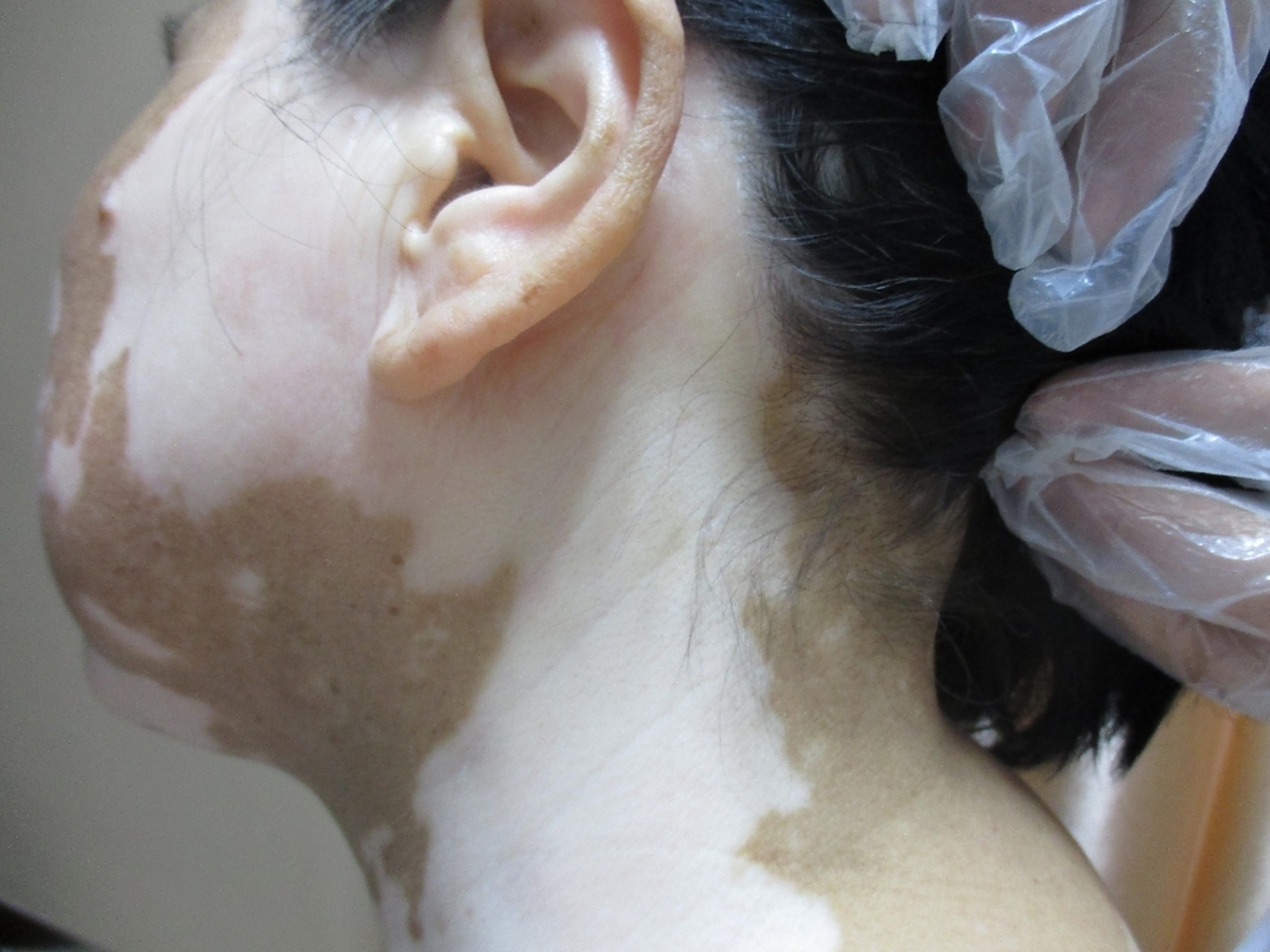 【白癜风早期与晚期的心态差异】 早期白癜风患者大多急于求成,对于