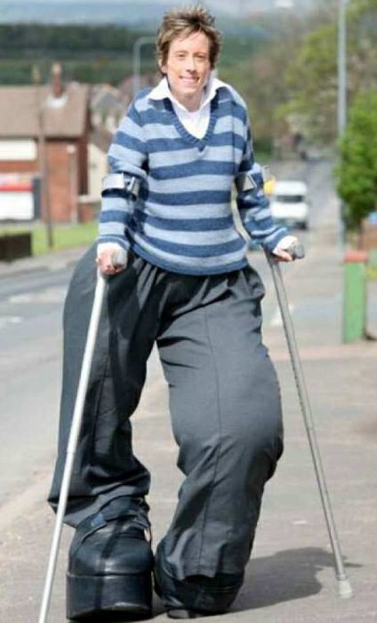 普秋罗斯综合症患者,全世界只有不到两百例.