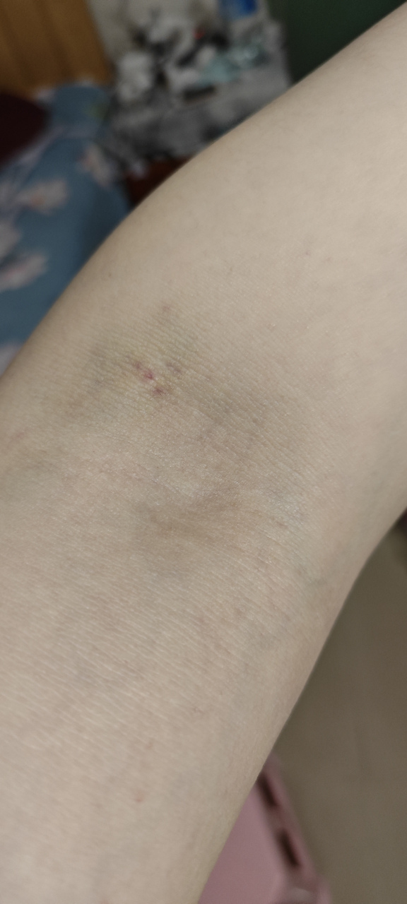 不知道是不是手机不行,抽血没多久针孔周围两三厘米一片黄的,不知道是