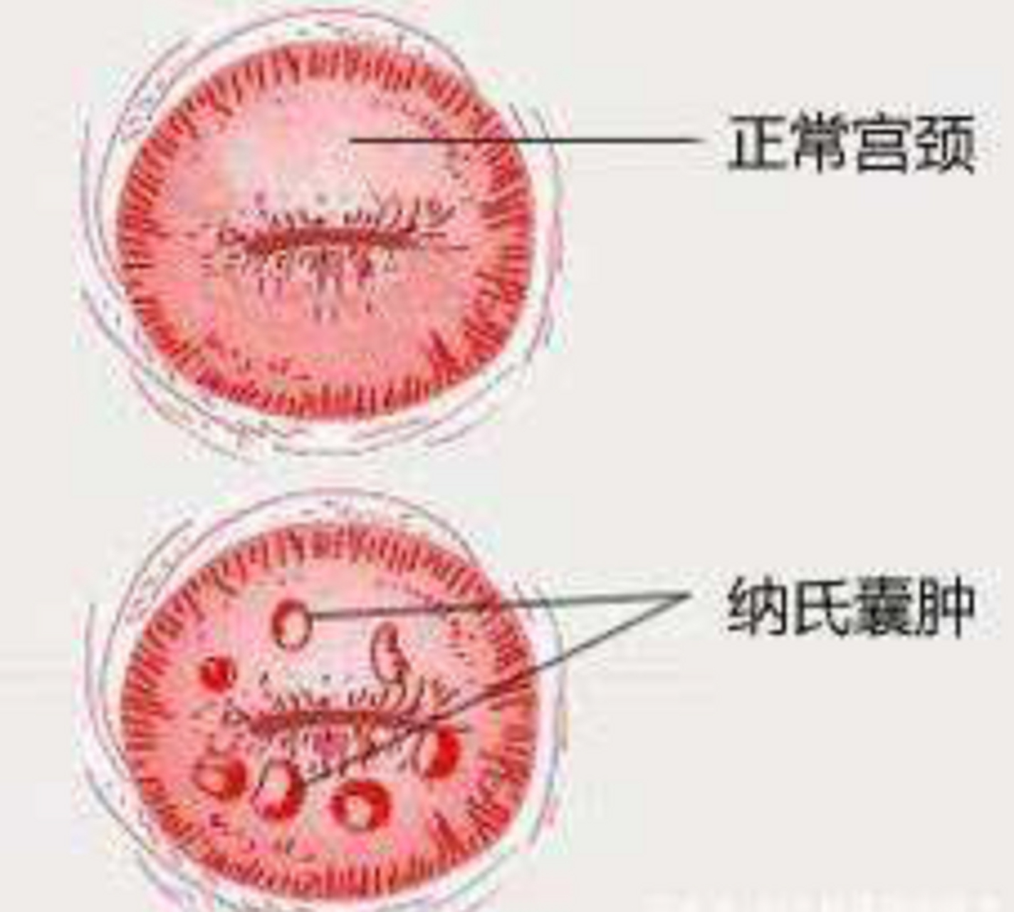 女性健康 宫颈纳氏囊肿又称宫颈腺囊肿,子宫颈转化区内鳞状上皮取代