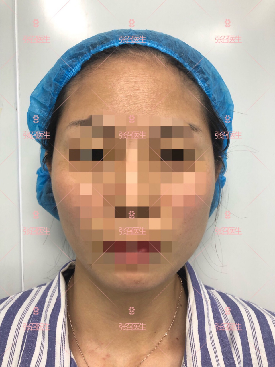 很多人颞部凹陷面积比较大,向上延伸到额部,或者