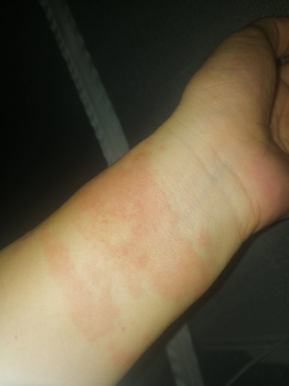 手腕上过敏红色疙瘩,特别痒痒,两个手腕轮着起,咋回事儿啊?