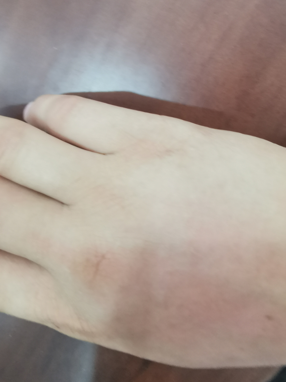 手痛第四天,手腕肿稍消,却向中指转移,中指几乎不能动.